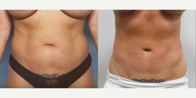 Liposculpture before and after photo