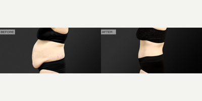 Liposuction before and after photo