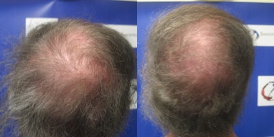 PRP for Hair Loss before and after photo