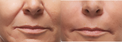 Radiesse before and after photo