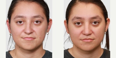Septoplasty before and after photo