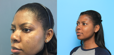 African American Rhinoplasty before and after photo