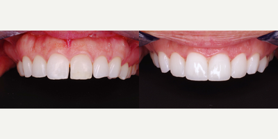 Dental Bonding before and after photo