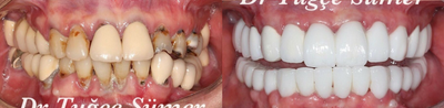 Dental Implants before and after photo
