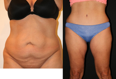 Drainless Tummy Tuck before and after photo