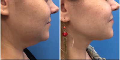 Liposculpture before and after photo