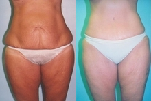 Liposuction before and after photo