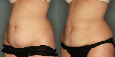 CoolSculpting before and after photo