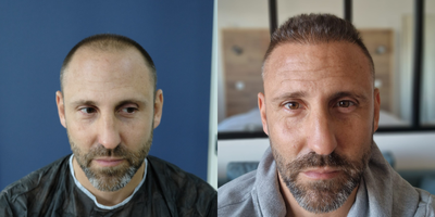 Hair Loss Treatment before and after photo
