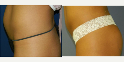 Liposuction before and after photo