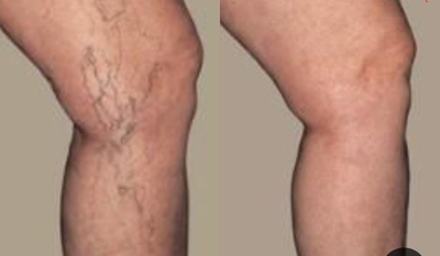 Sclerotherapy before and after photo