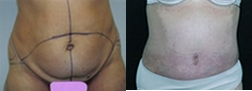 Tummy Tuck before and after photo