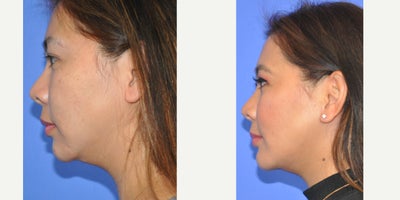 Neck Lift before and after photo