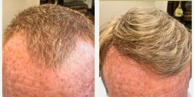Hair Loss Treatment before and after photo