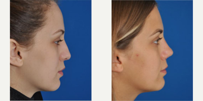 Revision Rhinoplasty before and after photo
