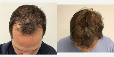 NeoGraft before and after photo