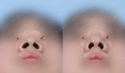 Rhinoplasty before and after photo