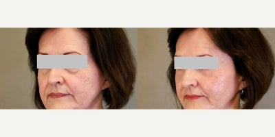 CO2 Laser before and after photo