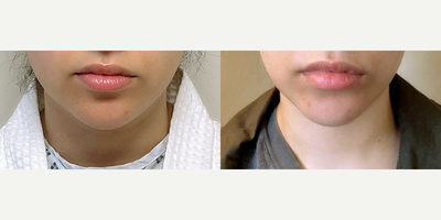 Liposuction before and after photo