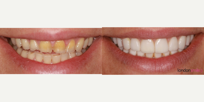 Porcelain Veneers before and after photo
