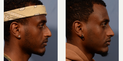 Rhinoplasty before and after photo
