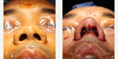 Rhinoplasty before and after photo