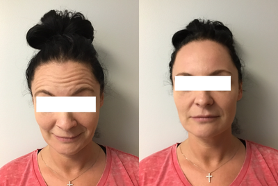 Botox before and after photo