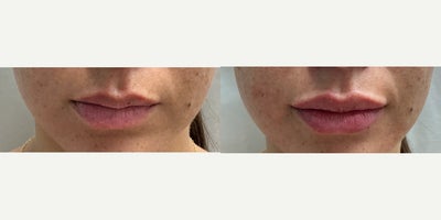 Lip Fillers before and after photo