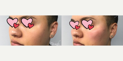 Cheek Augmentation before and after photo