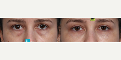 Dermal Fillers before and after photo