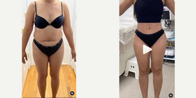 Tummy Tuck before and after photo