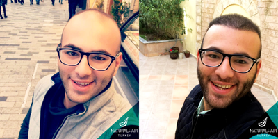 FUE Hair Transplant before and after photo