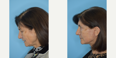 Mini Neck Lift before and after photo