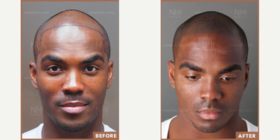 Scalp Micropigmentation before and after photo