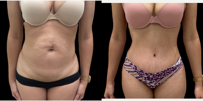 Tummy Tuck before and after photo