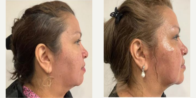 Chin Filler before and after photo
