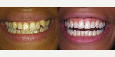 Invisalign before and after photo