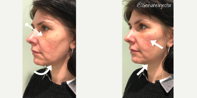 Juvederm before and after photo