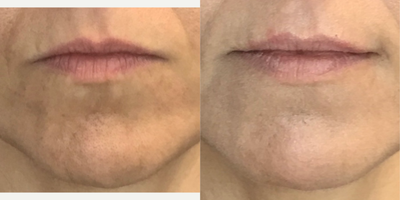 Lip Fillers before and after photo