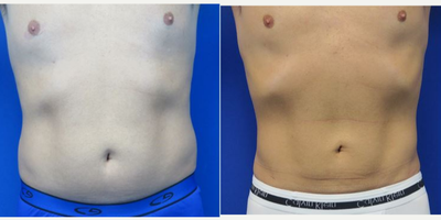 Liposuction before and after photo