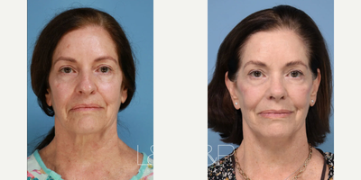 Neck Lift before and after photo