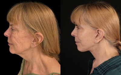 Neck Lift before and after photo