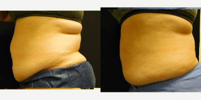 CoolSculpting before and after photo