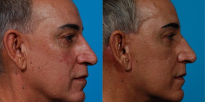 Facelift before and after photo