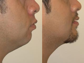 Genioplasty before and after photo