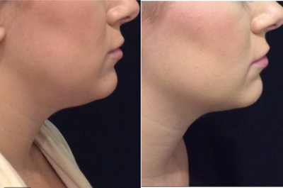 Kybella before and after photo