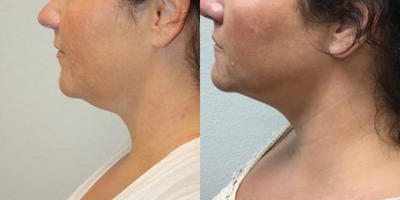 Kybella before and after photo