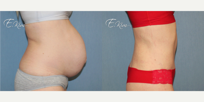 Liposuction before and after photo
