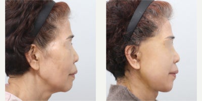 before and after image