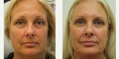Botox before and after photo